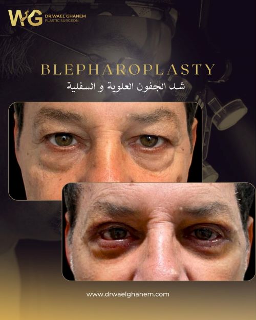 أفضل دكتور شد الجفون في مصر